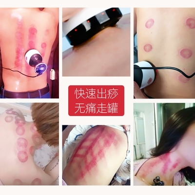艾灸拔罐一体罐与电动刮痧仪 传统养生与现代科技的完美融合